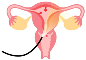 Hysteroscopy